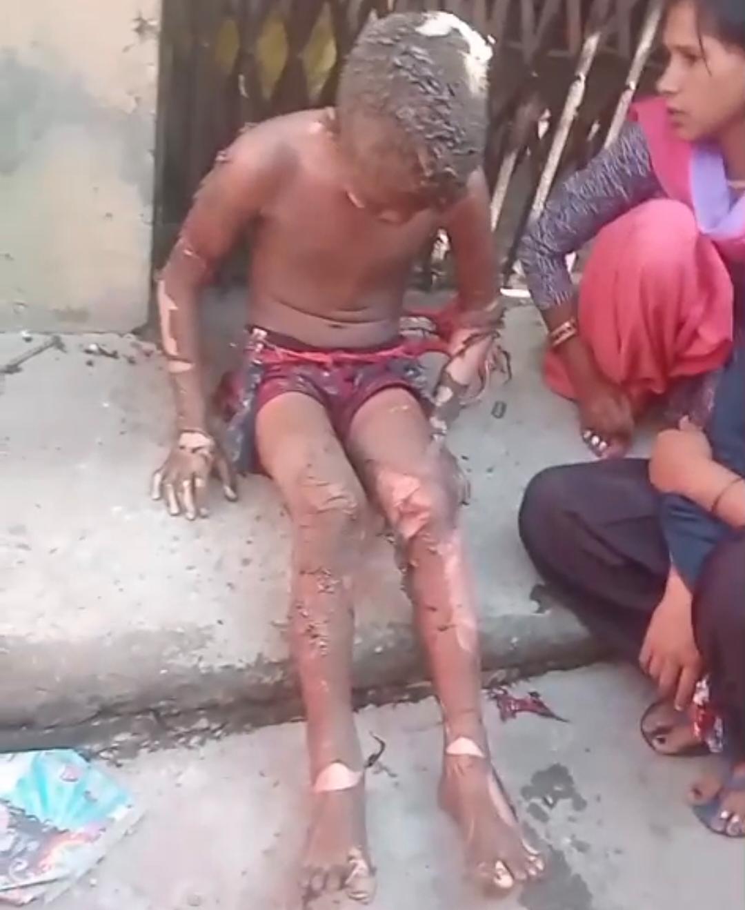 रुद्रपुर: सिलेंडर ब्लास्ट से मचा हड़कंप, पिता-पुत्र समेत 4 झुलसे, दो की हालत गंभीर